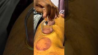 IT Band Tightness? Dry Cupping Relief | Mr Physio 01