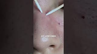 모낭충 관리법
