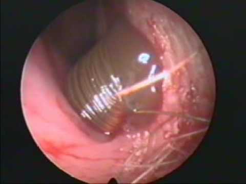 removal worm face Ahilasamy VIDEO: ENT the in Dr Live Cockroach Ear removal worm face Ahilasamy VIDEO: ENT the in Dr Live Cockroach Ear