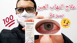 علاج التهاب ملتحمة العين الفيروسي بقطرات أوبتانول OPATANOL