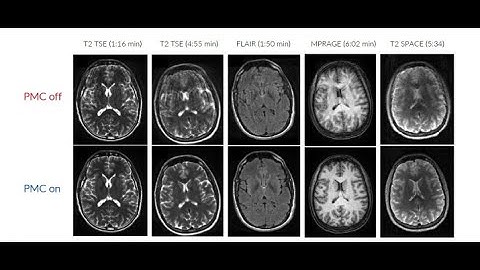 TCL : Prospective/Retrospective Motion correction solution for MRI scanner