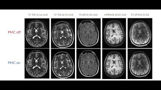 TCL : Prospective/Retrospective Motion correction solution for MRI scanner