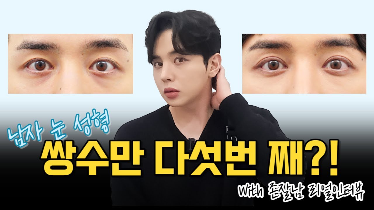 [奧羅整形外科診所] #男性眼部整形 #雙眼皮手術竟然已經第五次？！ #驚 終於奧羅也有神顏值帥哥了？！😝 男性眼部修復手術 | 男性雙眼皮手術 | 真實案例模特 💞