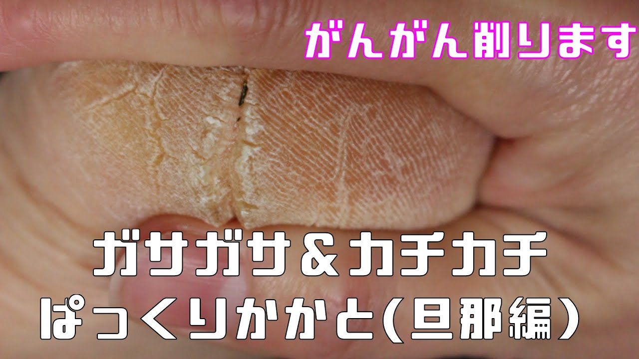 角質除去 ぱっくりかかとおうちで簡単にケアするよ Youtube 角質除去 ぱっくりかかとおうちで簡単にケアするよ Youtube