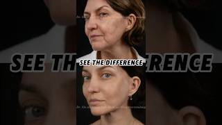 A subtle change can quietly change the whole face. #FacialLifting #aestheticsurgery
