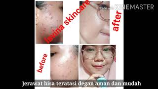 #lavinaskincare #lavinaskincareboming lavina skincare makin banyak peminatnya