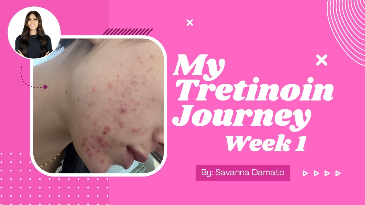 My Tretinoin Journey Week 1 YouTube