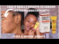 Dermopal Blemish Cream For Over A MONTH and I Have Thoughts || HYPERPIGMENTATION AND EVEN SKINTONE