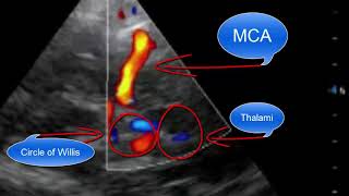 Transcranial Doppler Point of Care Ultrasound by westernsono 28,829 views 6 years ago 15 minutes