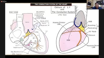 His Bundle Pacing by Dr. Dilip Kumar sir