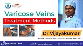 Varicose veins treatment methods | Dr Vijayakumar | Avis Hospitals