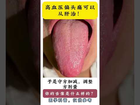 高血压偏头痛可以从肝治！,健康养生,中医药