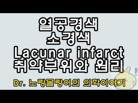 소경색(small artery occlusion), 열공경색(lacunar infarction) 기전(mechanism)과 취약부위