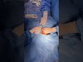 Femoral Line Insertion Before Craniofacial Hyperteleroism Correction