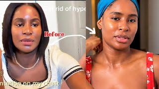 How I Got Clear, Radiant Skin — Niacinamide + Azelaic Acid Routine