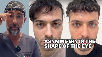 Asymmetry in the shape of the eye