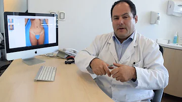 ¿Cuánto tarda una abdominoplastia en tener un aspecto normal?