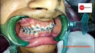 class II Division 2 treatment/ braces / orthodontic treatment