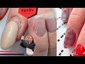 DENT IN NAIL PLATE, Transformation On Damaged Nails W/ Gel