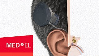 The MAESTRO Cochlear Implant System from MED-EL with RONDO | 3D | INT