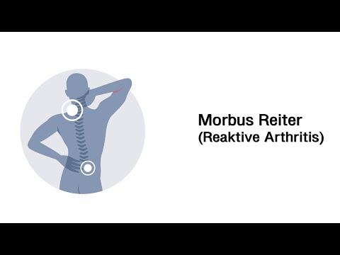 Video: 6 Behandlungen Für Reaktive Arthritis