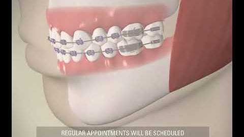 How Teeth Move With Braces | Braces working process animation | Orthodontic treatment animation