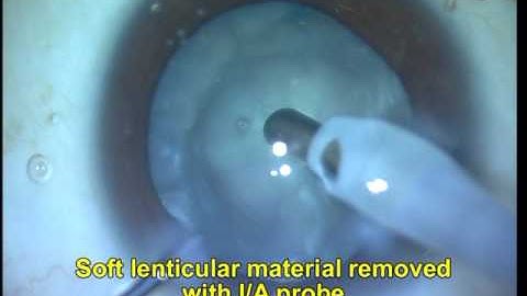 White cataract phaco for beginners Part 1 Soosan Jacob with audio 5 min