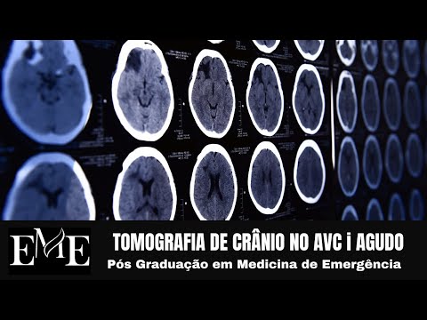 Vídeo: A Inibição Do MiR-19a Protege Os Neurônios Contra O AVC Isquêmico Através Da Modulação Do Metabolismo Da Glicose E Da Apoptose Neuronal