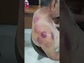 Cupping therapy for shoulder pain  frozen shoulder  gym injury  drpadhiyar shorts