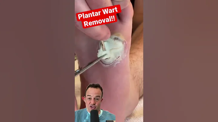 DOCTOR REACTS: SATISFYING WART REMOVAL!😱 #shorts