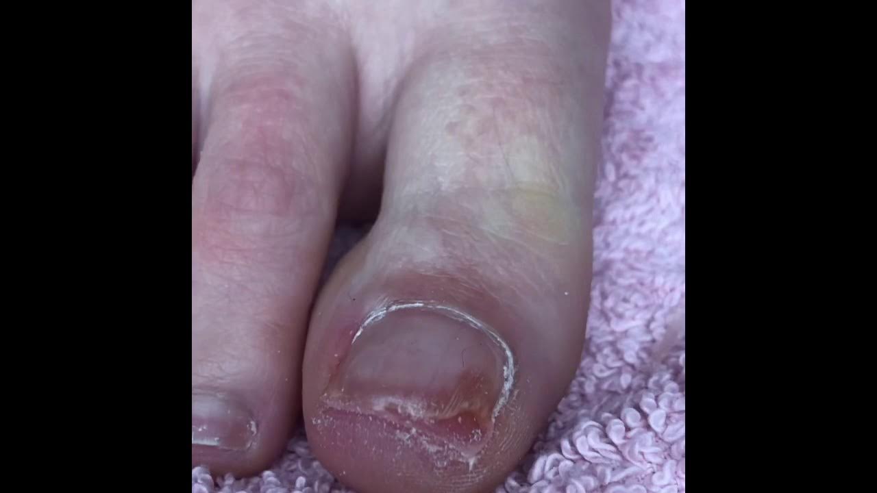 Nail reconstruction part 1 - YouTube