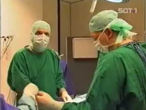 videa videa de operare chiricica varicosa)