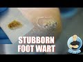 HOW TO TREAT DIFFICULT PLANTAR WARTS REMOVAL - FOOT HEALTH MONTH 2018 #9