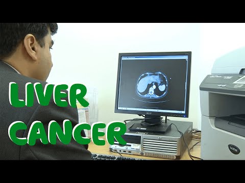 Video: Hoe leverkanker te diagnosticeren (met afbeeldingen)