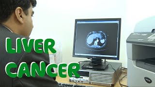 What Is Liver Cancer? (Symptoms, Causes & Treatments)   Macmillan Cancer Support