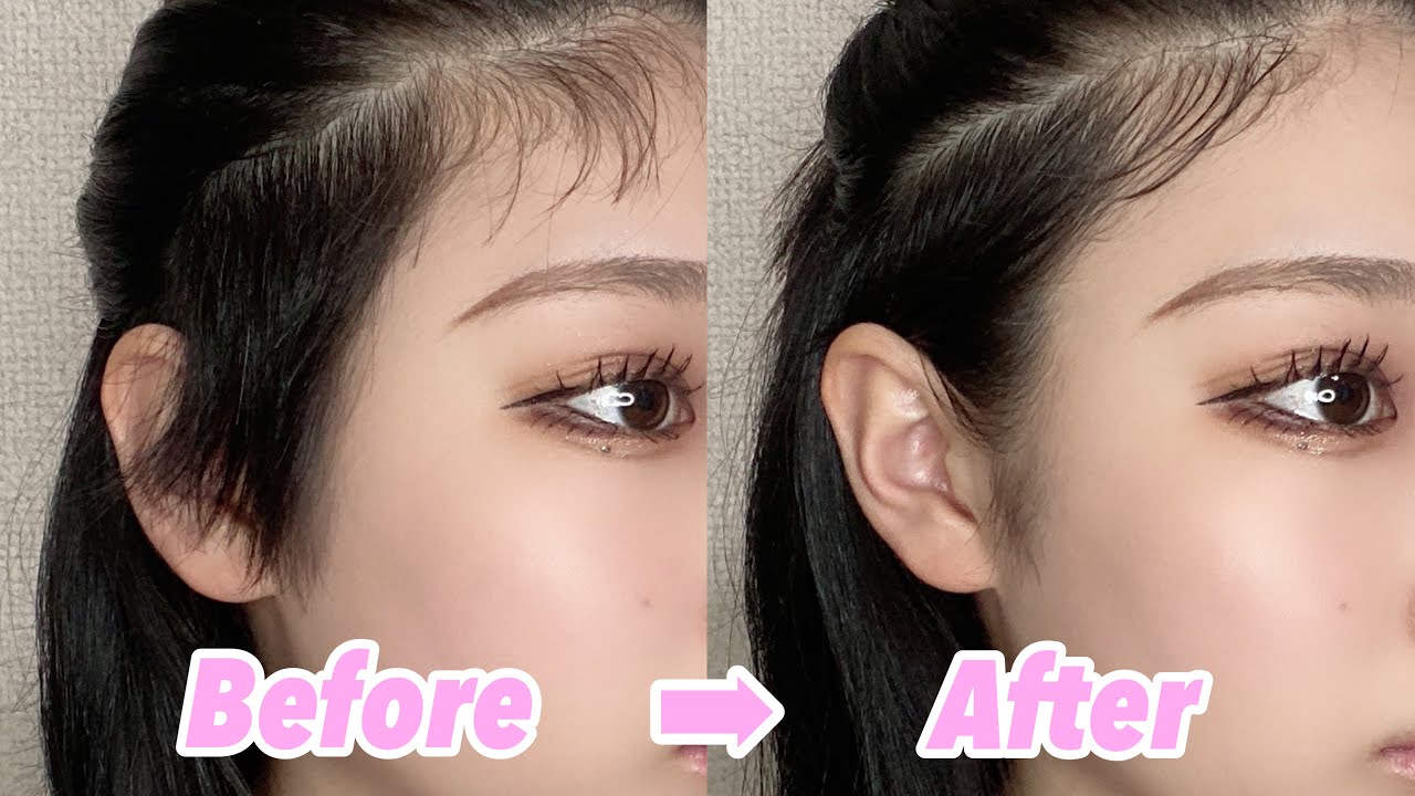 産毛と伸びかけ刈り上げの処理方法