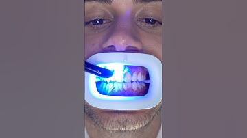 Transformation of Yellow Teeth! #teethwhitening
