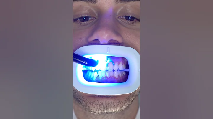 Transformation of Yellow Teeth! #teethwhitening