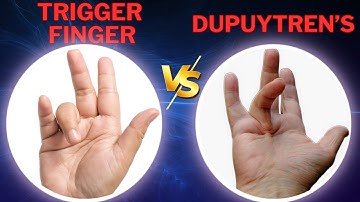 Trigger finger vs Dupuytren