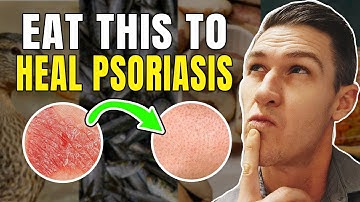 5 Foods to Eat if you Have Psoriasis | How to Treat Psoriasis