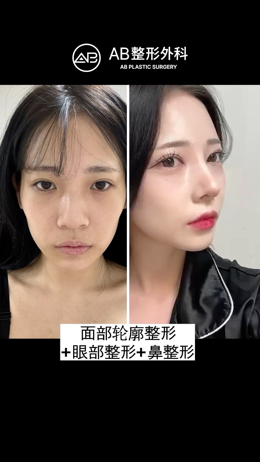 她做了眼鼻輪廓手術，結果驚呆了大家！#shorts