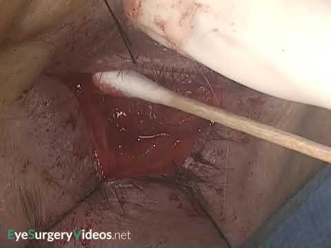 Secondary orbital ball implant and buccal mucosa fornix reconstruction