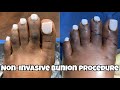 MINIMALLY INVASIVE BUNION PROCEDURE AND UNSIGHTLY CORN REMOVAL - (BY DR. NUNEZ & DR. WAGNER)