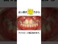 ワイヤーではなくマウスピース矯正で治したい方必見#shorts #矯正#歯列矯正#マウスピース #マウスピース矯正#歯並び #インビザライン#八重歯