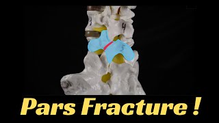 What is a pars fracture? Everything you need to know.