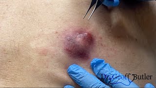 Drainage Of An Inflamed Epidermal Cyst On The Back