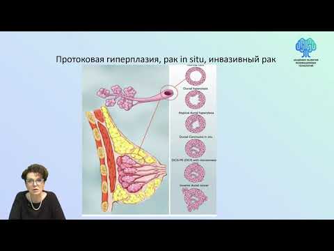 Видео: Метаплазията доброкачествена ли е или злокачествена?