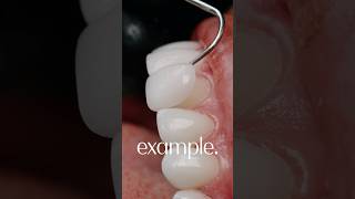 Minimal Prep Veneers