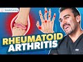 Rheumatoid arthritis diagnostics  nursing immunosuppressants osteoarthritis