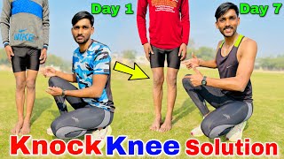 Knock knee कैसे ठीक करें | Knock knee problem solution | knock knees best exercise and tips in hindi